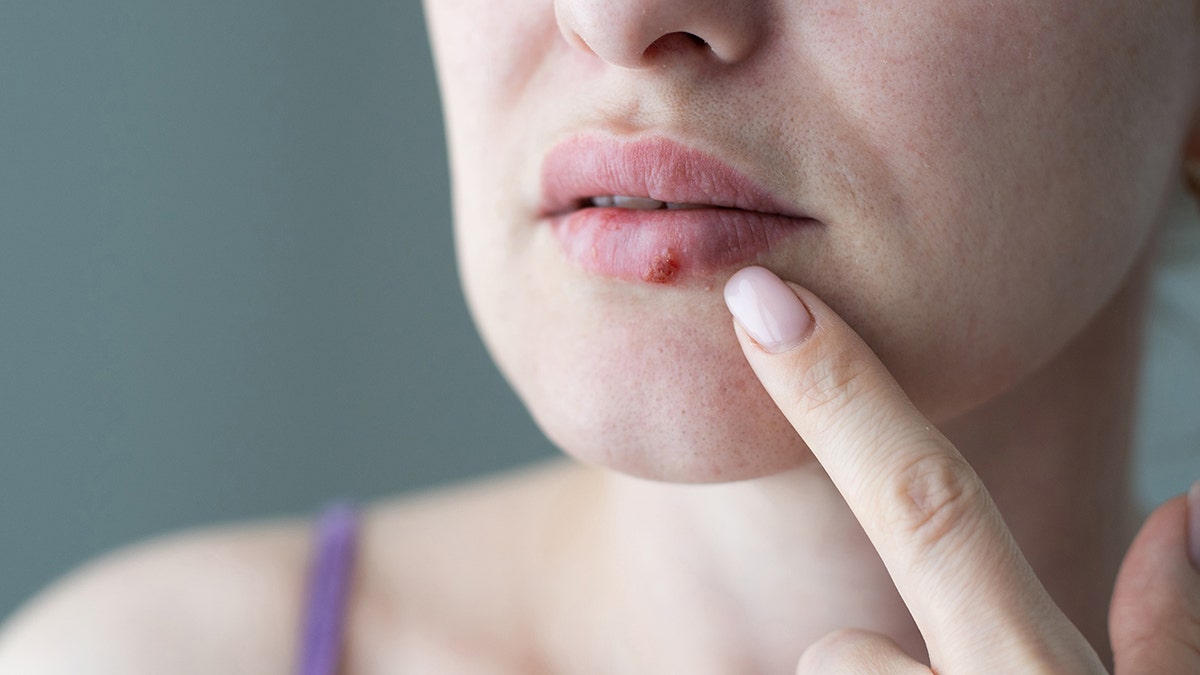 Woman with Coldsore, a mouthpiece in the mouth