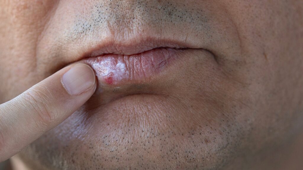Cold sores may play a role in the development of Alzheimer's, reveals a new research